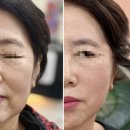 31140-8-60-14 | 인천 실리프팅 부평 성형외과 안면거상 60대 실리프팅 효과 후기 有