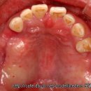 어금니를 여러개 상실했을 때 ▶ 뼈이식을 동반한 임플란트 이미지