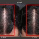 서울숭신초등학교 | 성동구탈모병원｜탈모약 고민하다 선택한 리제네라액티바, 탈모치료 7개월차 후기