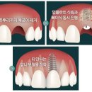 찬스치과기공소 | 앞니 임플란트 가격 후기