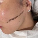 이노 | 부평스킨플래닝 진화된 엑시드닝 이노왁싱 후기