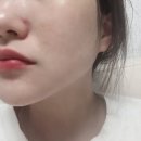 가나디자인 | 압구정로데오역 피부과 팔자주름없애기 가나브이 콜라겐부스터 후기