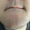 세종스노우의원 | 남자 제모 젠틀맥스프로플러스 10회 후기 : 세종 스노우의원