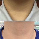 목주름 필러 내돈내산 부작용 가격 etc 찐 후기