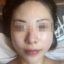 [송도피부관리] 더끌림스킨에서 물방울 리프팅 관리 받은 후기
