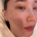 성옥이네집 | 우유빛의원 우마카세 4회차, 5회차 후기 ㅣ 잡티레이저로 주근깨·기미·흑자 관리 받은 솔직 리뷰