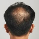 정수리 이미지