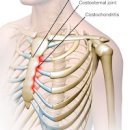 왼쪽 갈비뼈 아래 통증 원인 5가지 및 방법 이미지