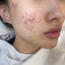 홍대 여드름 피부관리 미더베스트 에스테틱 칵테일필 약초필 후기