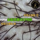 대구 두피관리 샵 숲칼프 동대구역점에서 두피관리 받고 온 후기