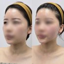 톡톡 우쿨렐레 | [대구 북구] 알테온 윤곽관리로 유명한:널 위한 뷰티/ 안 아픈 리프팅 관리