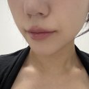 봄눈피우다의원 | 장원영 입술 원해요? 홍대 입술필러 1cc 전후 비교 (봄눈피우다의원)+최근 모습