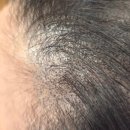 서울 헤어라인 문신, 20대~30대 여성이 대부분 실패하는 결정적인 이유