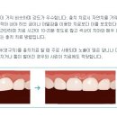 앞니 벌어짐 치료 비용 문의 드립니다~ 이미지