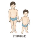 연골무형성증[Achondroplasia]유전질환 이미지