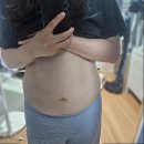 자영약국 | 급빠 다이어트로 대구 복부 지방흡입 택 (수술당일~일주일차 멍,붓기,사이즈변화) 상세 후기!