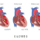 심장비대증, 확장성 심근병증 & 비후성 심근증 및 (호흡곤란) 이미지