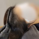 SUN 스칼프 크리닉 | 광교/sun스칼프 크리닉 소중한 내 두피지켜!!