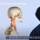 흉쇄유돌근 기능 및 통증, 마사지 (방사통) 이미지