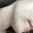 만성트러블] 내인생 최대의 접촉성피부염 (내돈내산 화장품 추천후기)👍시드물, 폴라초이스,더랩바이블랑두