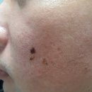 더리치의원 | [내돈내산] 압구정 리치모아의원 - 줄기세포 흉터복원술 후기(2)