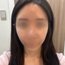 케이메디컬의원 | “피부 탄력 업! 엘레브의원 울쎄라피프라임2 + 쥬베룩 볼륨 리얼 리뷰” (+수면마취)