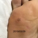 동아에이알시㈜ | 족저사마귀 완치 후기, 사마귀 / 티눈 자가치료, 두오필름겔 대체약
