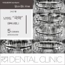 이승현치과의원 | 완전매복사랑니 발치 후기 케이스 5 (feat. 수면마취)