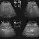 Abdomen 실제 초음파 이미지