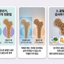 뼈 건강이 걱정되는 갱년기 후기? 낙상 위험 줄여주는 한약 치료!