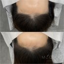 햇빛헤어라인 - 북구 | 햇빛헤어라인