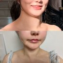 올림피움채움올피채의원 | 예비신부 이중턱관리 강남역 올피채의원 인모드FX 후기