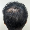 정수리탈모 강남두피문신, 리앤채움의원 3회 완성 리얼 후기