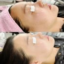 부천 피부관리 써니뷰티 에어플라즈마 모공 블랙헤드관리 후기