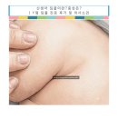 딤플 | 신생아 Y형 딤플 진료 후기｜L4 검사 결과와 의사 소견