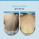 알라딘필링 | 상동 등드름 알라딘필링 후기 1회만에 이렇게 달라졌어요