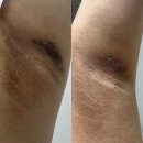 대전 멜라닌케어 뷰티뷰헤어라인 겨드랑이멜라닌케어 꼼꼼후기