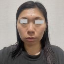 유진스 | 압구정로데오 피부과 눈밑필러 일주일 차 변화 기록