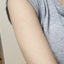 구로역 피부과 팔 레이저제모 1회차 내돈내산 후기