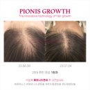 솔미용타운 | 탈모인들 사이에서 핫하다는 두피 타투 에센스의 효과는?