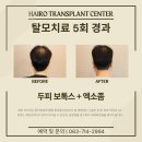 (주)서로돕는사람들 | 전주 탈모병원 후기 핵심 분석 포인트 네가지