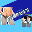 바디지방분해주사 세이렌의원 걸그룹주사후기(feat. 2일차)