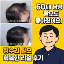 “60대 남성 탈모도 좋아졌어요!” – 하루 3번 식품 섭취로 정수리 탈모 회복한 리얼 후기