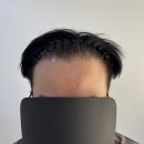 리게인프로젝트 부산점에서 두피커버로 자신감을 되찾았어요!