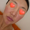 부안성모병원 | 홍조 주사피부염 치료일기 - 중앙대학교,연고,재생크림 내돈내산 5개월차 후기