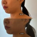 경락농장 | 광주 윤곽관리, 예비신부 관리 추천! 1회차 비포&amp;애프터 후기