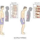 강직성척추염 증상 원인 치료 진단 엑스레이 MRI 이미지