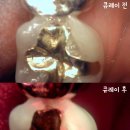 파주시치과 어금니 깊은 치아 크랙 큐레이 관찰 후 신경치료로 보존