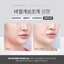보조개성형 후기 매력적인 미소를 위해서
