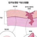 기관지염 침샘암 구강암 원인 증상 차이점 이미지